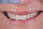 ​Il Dr. Maiolino illustra una riabilitazione estetico-funzionale del sorriso utilizzando restauri in ceramica feldspatica e corone in zirconio-ceramica. ​