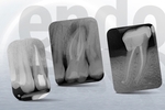 Protocolli di sagomatura canalare con il sistema FQ di Komet: tecniche operative per canali larghi, normali e calcificati.