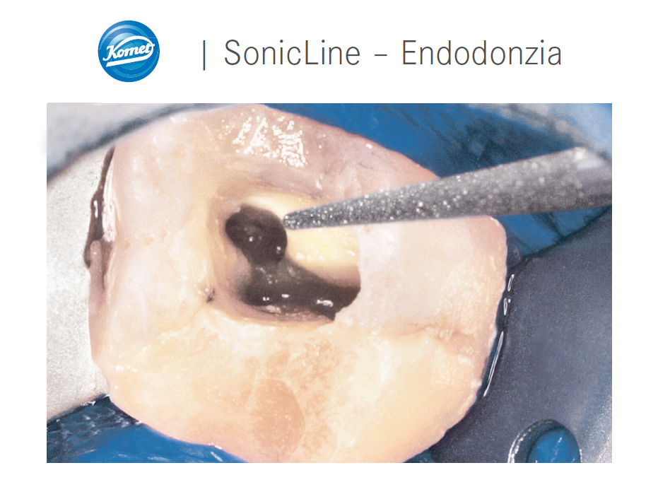 Nel trattamento endodontico gli inserti sonici permettono di lavorare con ottima visibilità e grande controllo, sfruttando anche l’effetto di cavitazione.