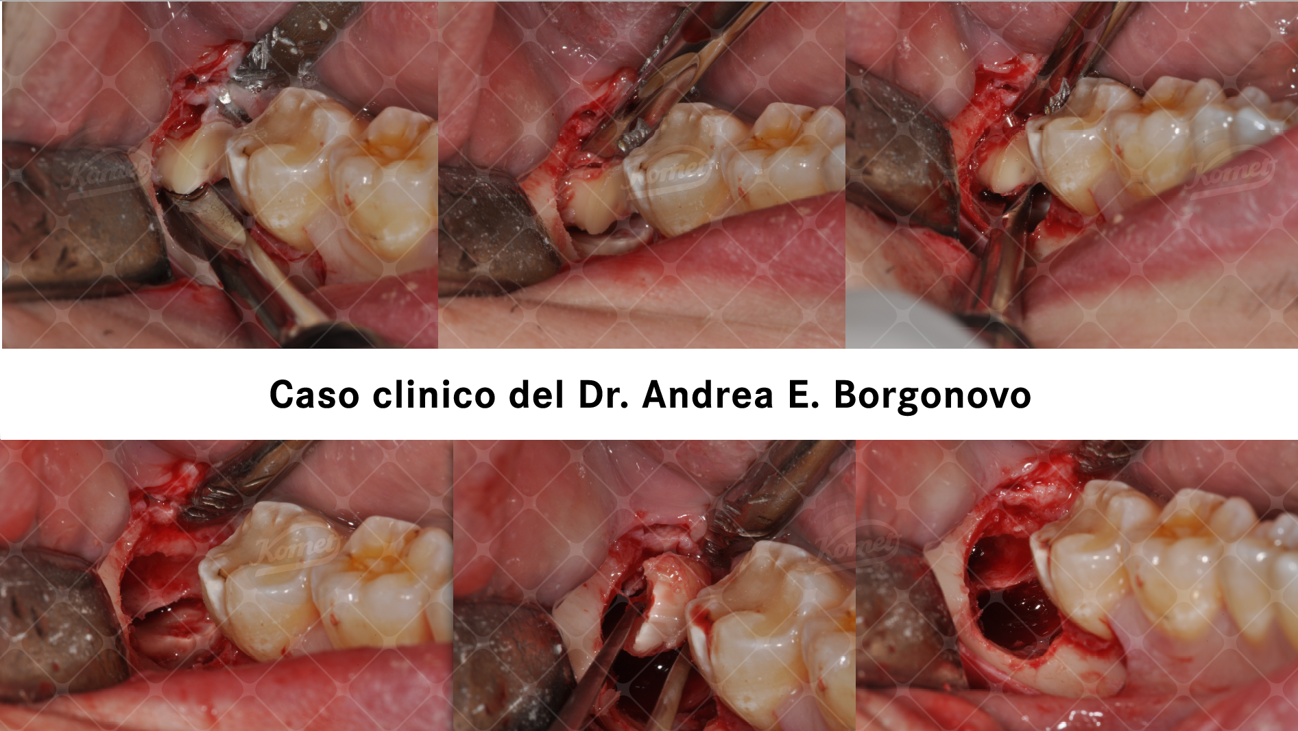 Procedura clinica: Lembo trapezoidale; Ostectomia Distovestibolare corticale; Ostectomia midollare; Odontotomia verticale con Coronectomia compl.; Rizotomia