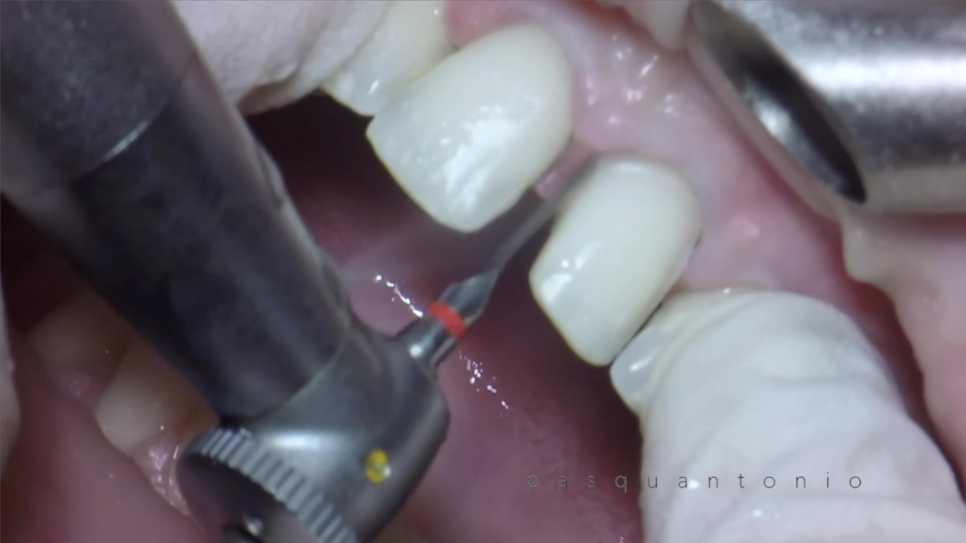 Lime DC1 per le fasi di rifinitura e sagomatura delle superfici incisali e interprossimali nella tecnica protesica per veneers faccette in ceramica.