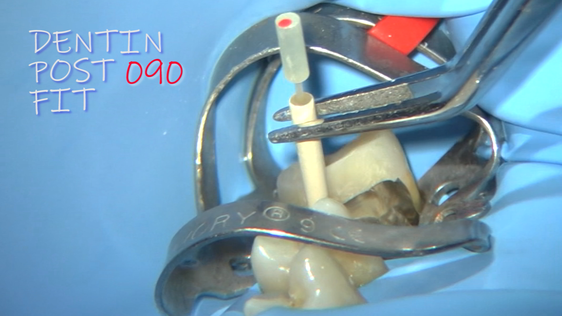 Il dente è stato ricostruito: è stato predisposto lo spazio nel canale palatino per il perno presilanizzato Dentin Post 090 ritoccato per meglio adattarlo