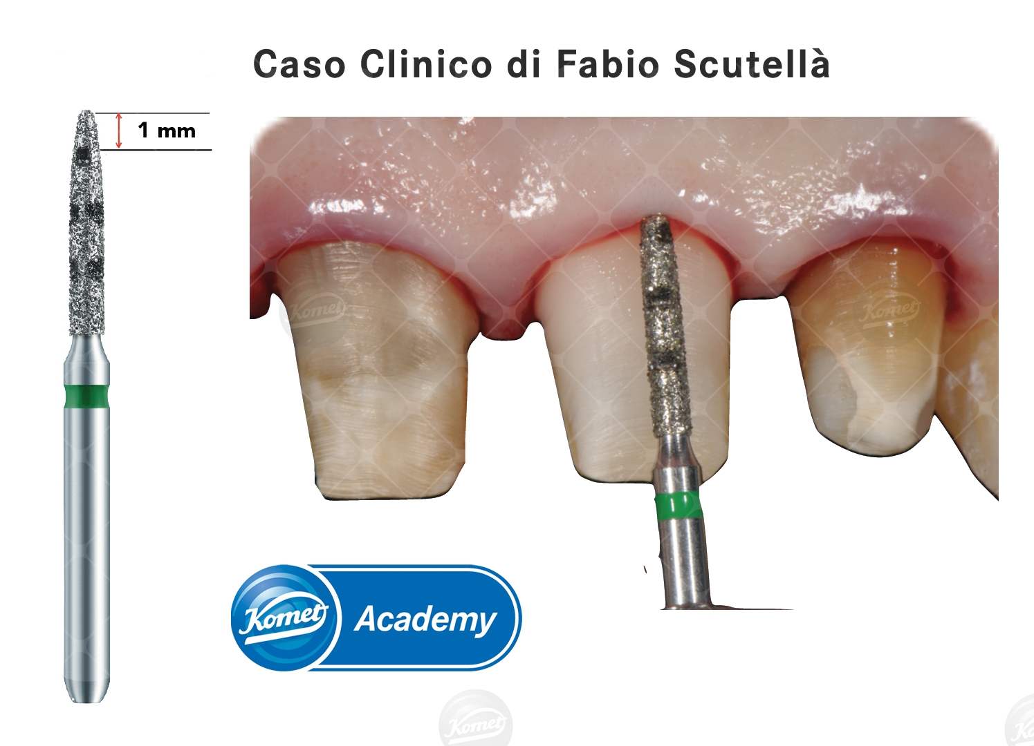 Le preparazioni verticali hanno la capacità di garantire un sigillo marginale migliore e producono una migliore risposta dei tessuti gengivali circostanti.