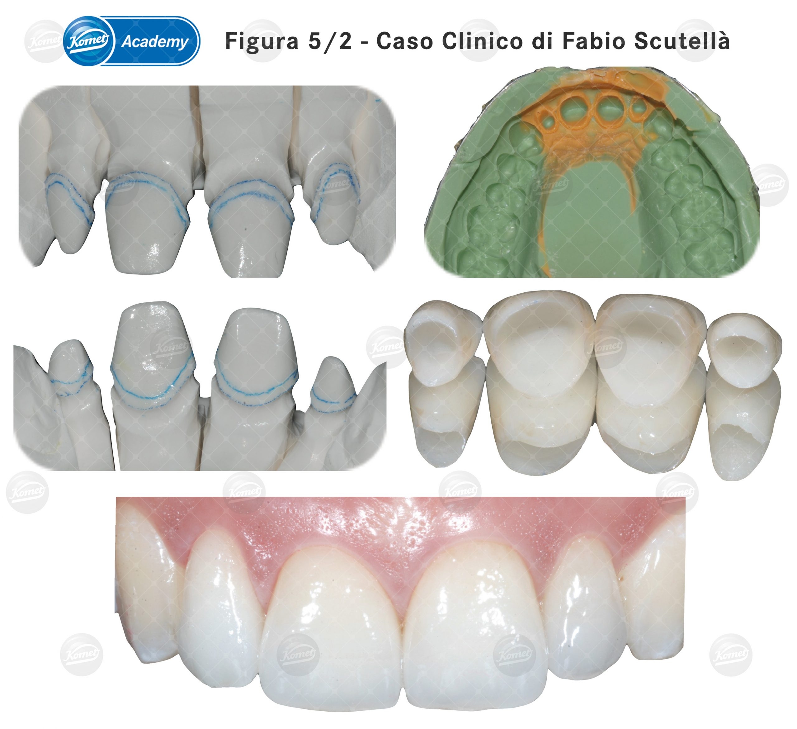 Frese FG Diamantate Verticali Dentali Tecnica Di Preperazione - Foto 2