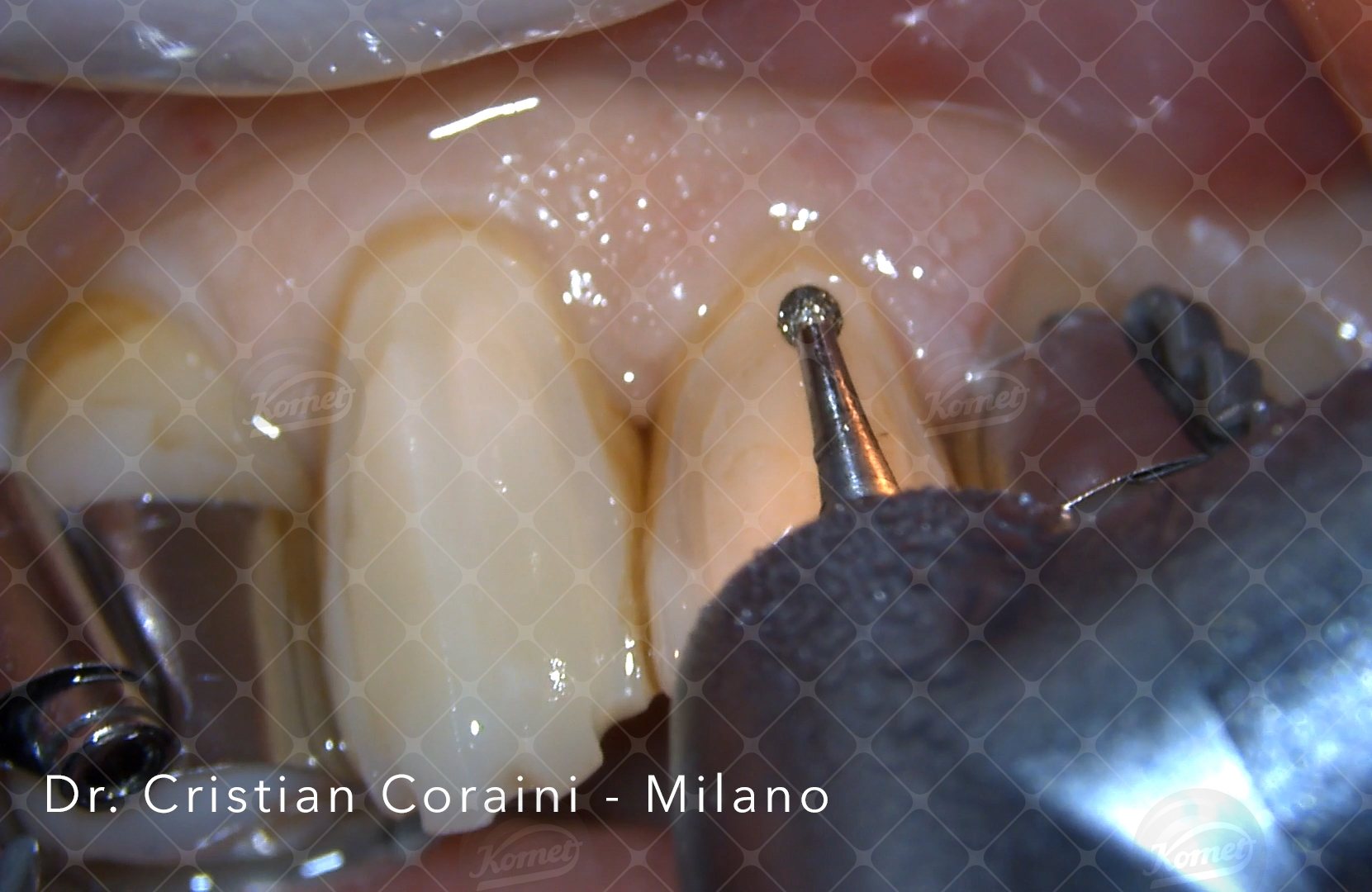 faccette in ceramica, mock-up, preparazioni protesiche minimamente invasive: paziente trattata protesicamente negli elementi dentali frontali inferiori.