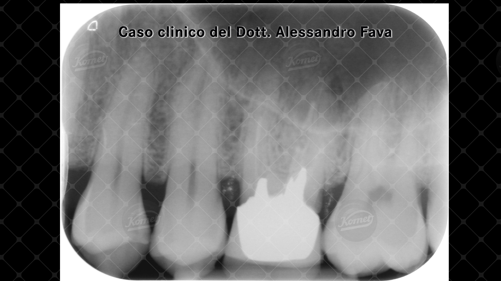 canale MV sagomato con F6 030, canale MV2 sagomato con F6 Skytaper 025, canale MV3 F6 Skytaper 025, canale DV sagomato con F6 Skytaper 030 e P con F360 045