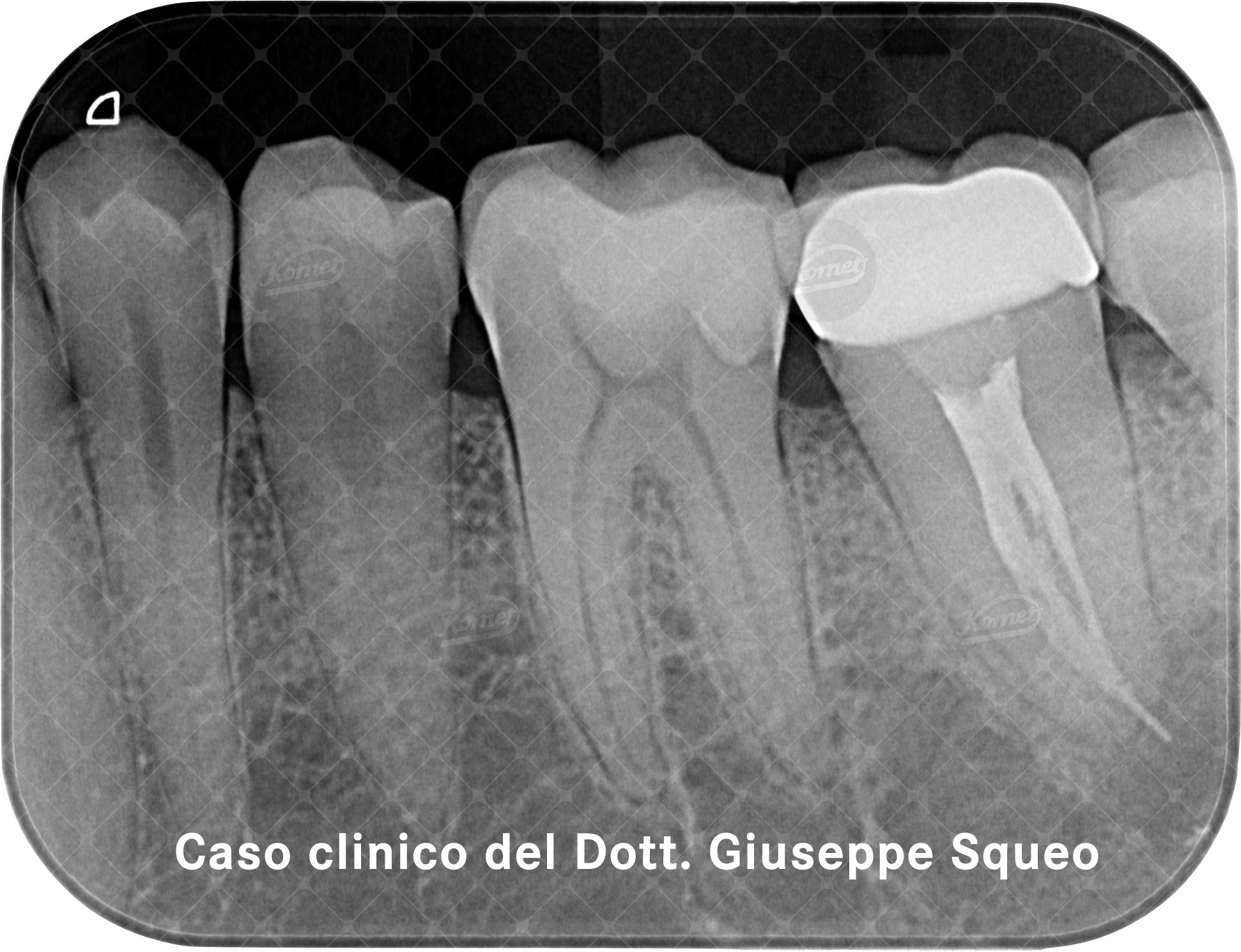 pulpite irreversibile dente 3.6 trattata con i seguenti strumenti Komet: PathGlider 015 per e un solo F6 SkyTaper 025 per tutti e 3 i sistemi canalari