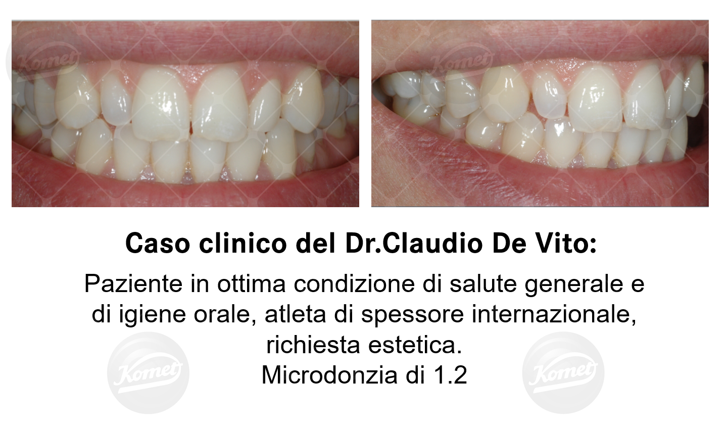 Corona in ceramica in un'unica seduta: lucidatura e glasura con gommini dedicati del Digital Prosthetic Essential Kit del Dr. Claudio De Vito