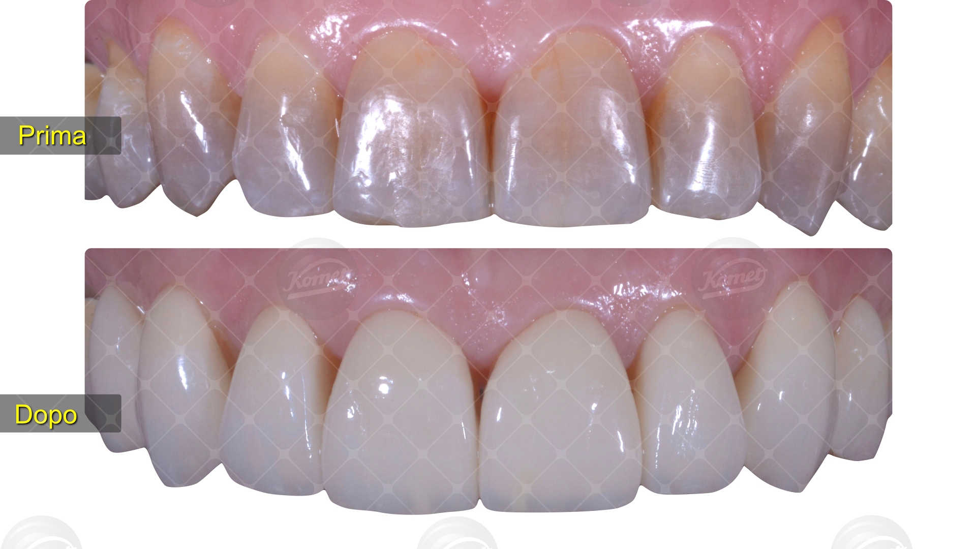 Il un sorriso affetto da macchie da tetraciclina su tutti gli elementi dentari si è provveduto alla loro ricopertura con veneer in ceramica adesiva.