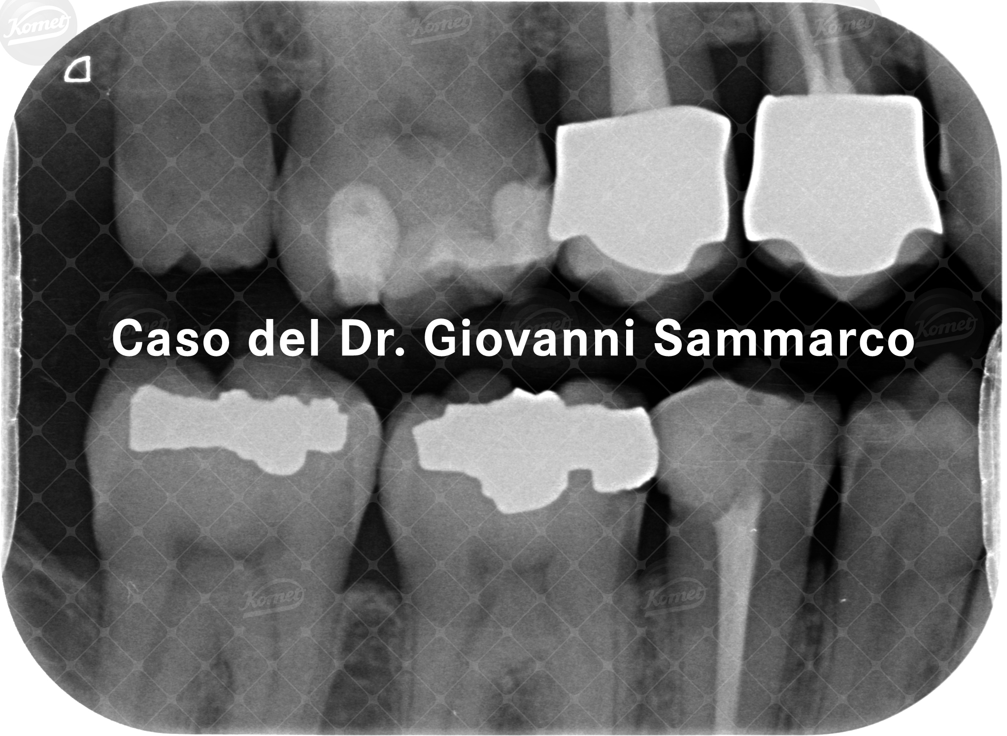 Lo slot orizzontale è una tecnica restaurativa minimamente invasiva: in questo articolo è visibile la tecnica DAST (Divarication Aided Slot Technique)