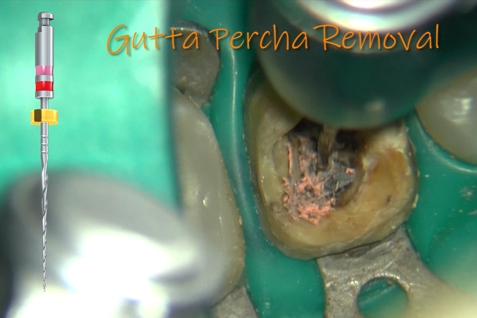 Con Komet ReStart ritrattamenti endodontici che permettono una rimozione rapida e completa del materiale presente all’interno dei canali radicolari
