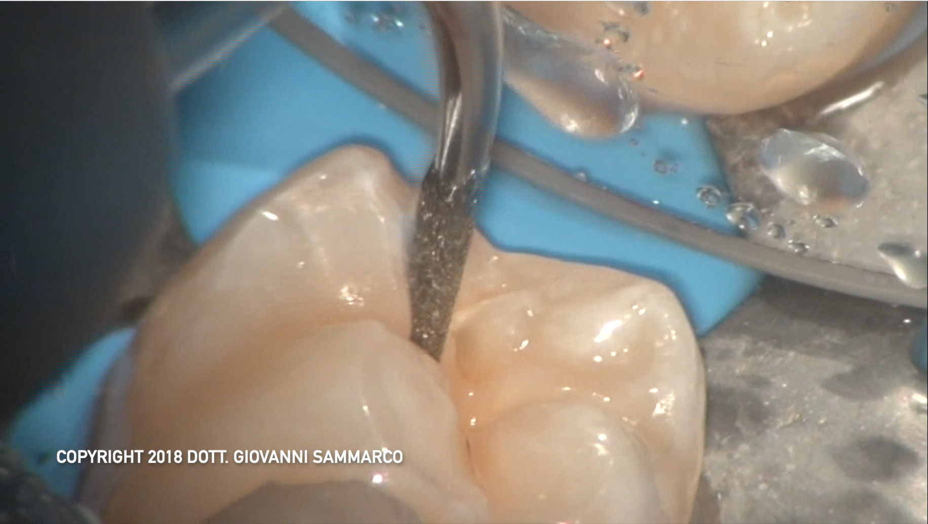Caso clinico dove è stata utilizzata la punta sonica Komet SF849 009 per ricercare e rimuovere le carie fissurali e per preparare i solchi occlusali.