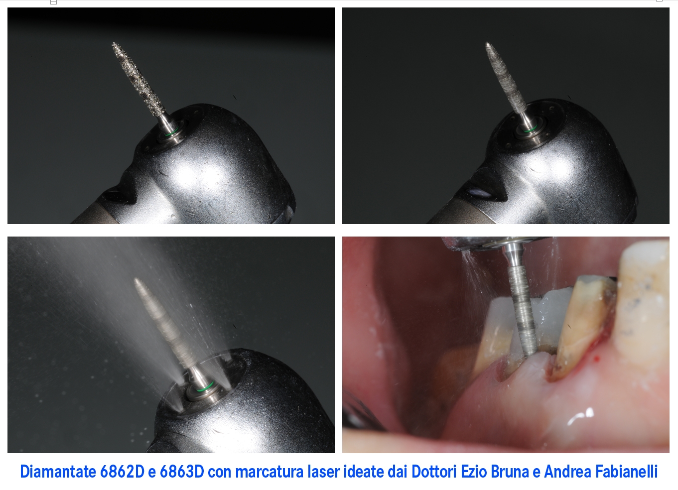 Grazie alle marcature laser, con le diamantate 6862D e 6863D l’odontoiatra riesce a valutare con sicurezza la profondità di penetrazione nel solco gengivale Grazie alle marcature laser, con le diamantate 6862D e 6863D l’odontoiatra riesce a valutare con sicurezza la profondità di penetrazione nel solco gengivale