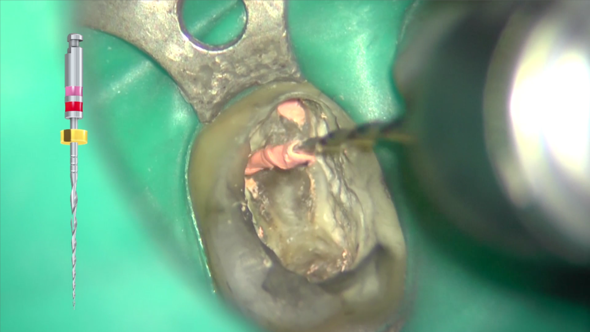 Komet Endo ReStart si dimostra molto efficace anche nella sempre più frequente possibilità di dover rimuovere guttaperca associata a carrier in plastica