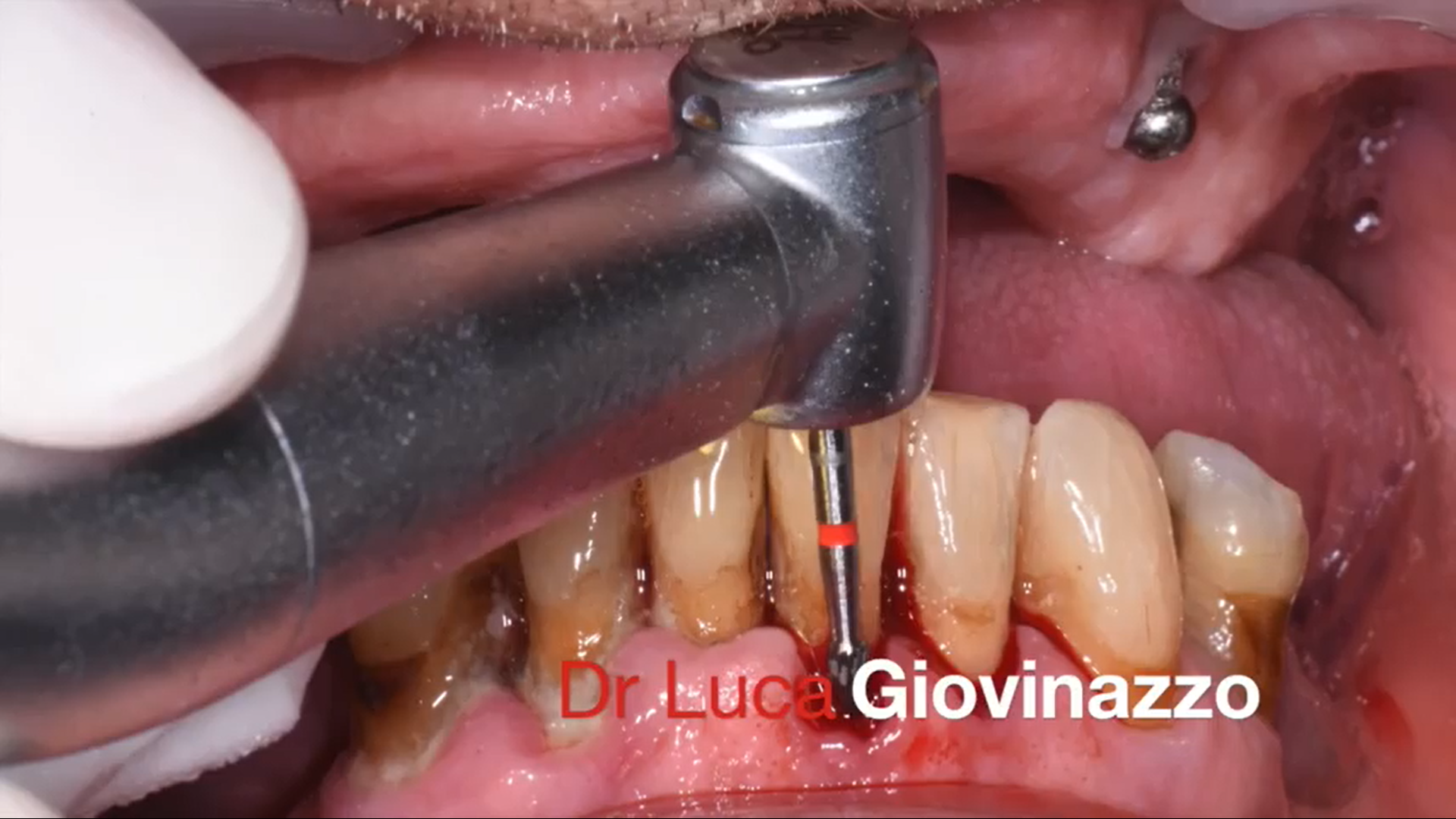 Il Dr. Luca Giovinazzo illustra l’impiego della fresa in carburo di tungsteno: l’accumulo di placca viene rimosso conseguendo una superficie pulita e liscia