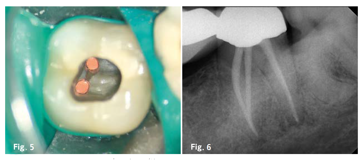 Procodile convince per l'estrema capacità di taglio e l’ottima controllabilità con pressoché nessun effetto di avvitamento. Aumenta la sicurezza clinica.