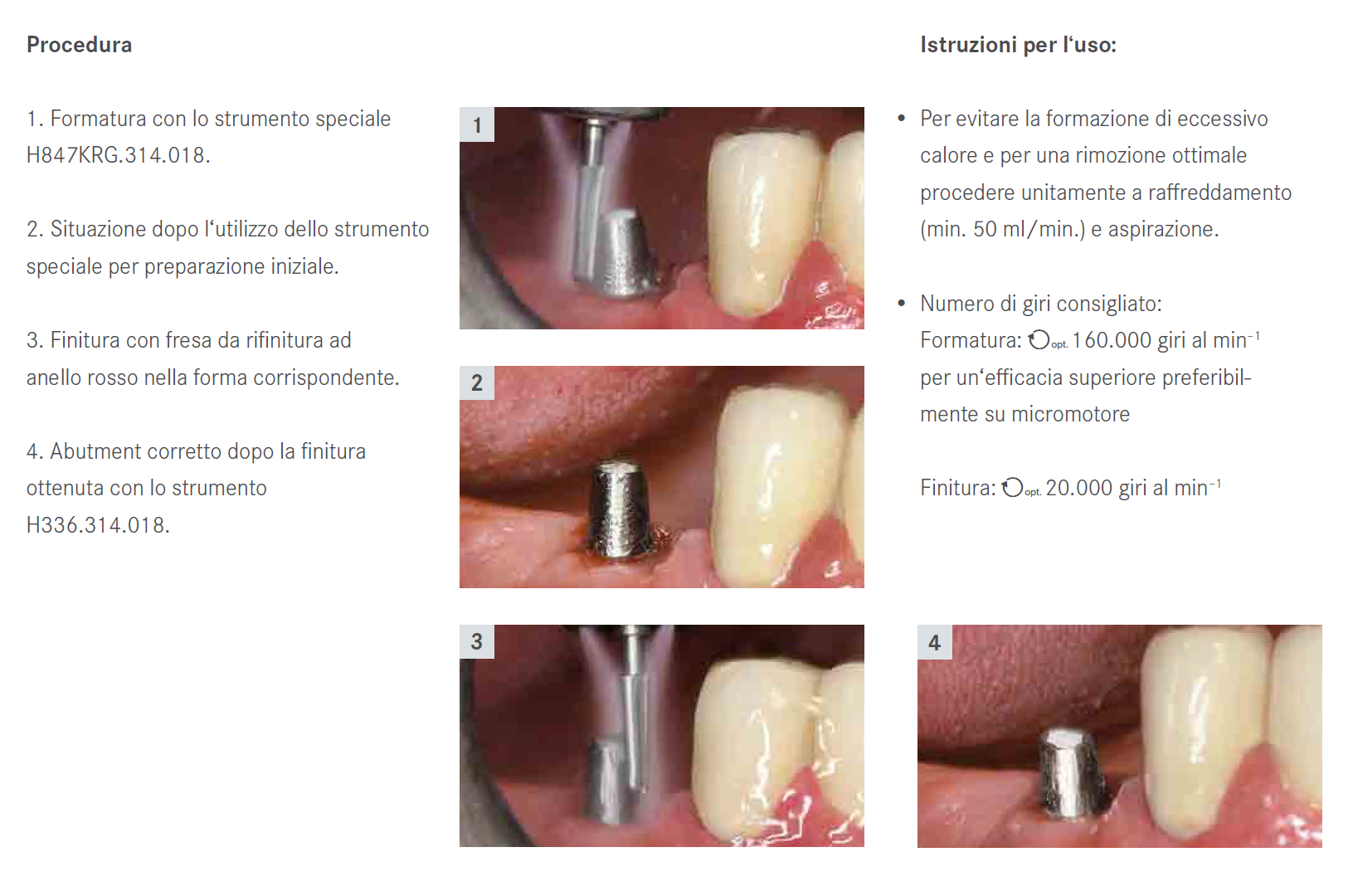 Per ritocchi intraorali sul titanio Komet ha sviluppato le frese in carburo di tungsteno a taglio G con dentatura superaffilata che evita di impastare