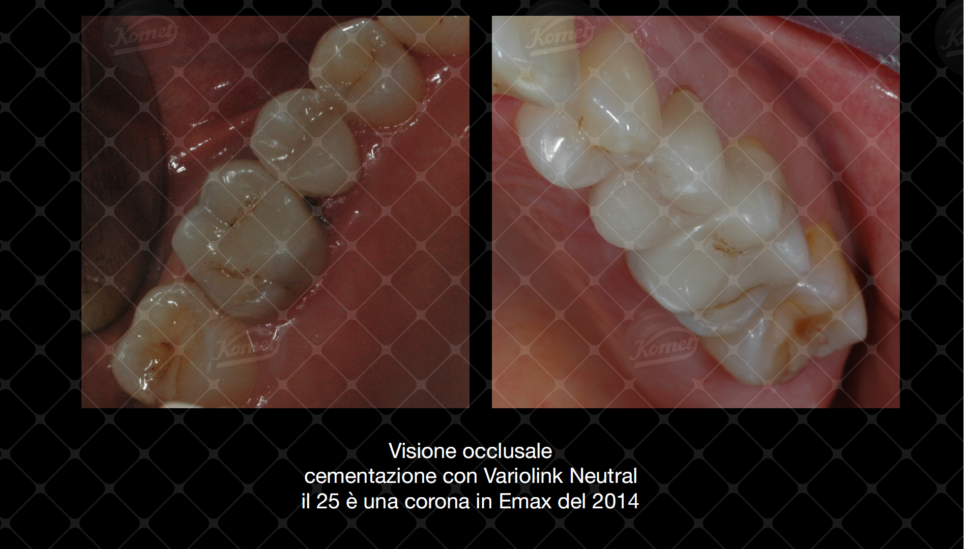 Restauro in amalgama da sostituire: scansione della cavità e progettazione del restauro fresato con CEREC da blocchetto di Ivoclar Tetric in composito.