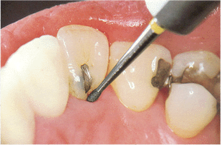 Set 4362 per curare la superficie radicolare di denti affetti da problemi parodontali: diamantate per levigare con la medesima efficacia delle curette.