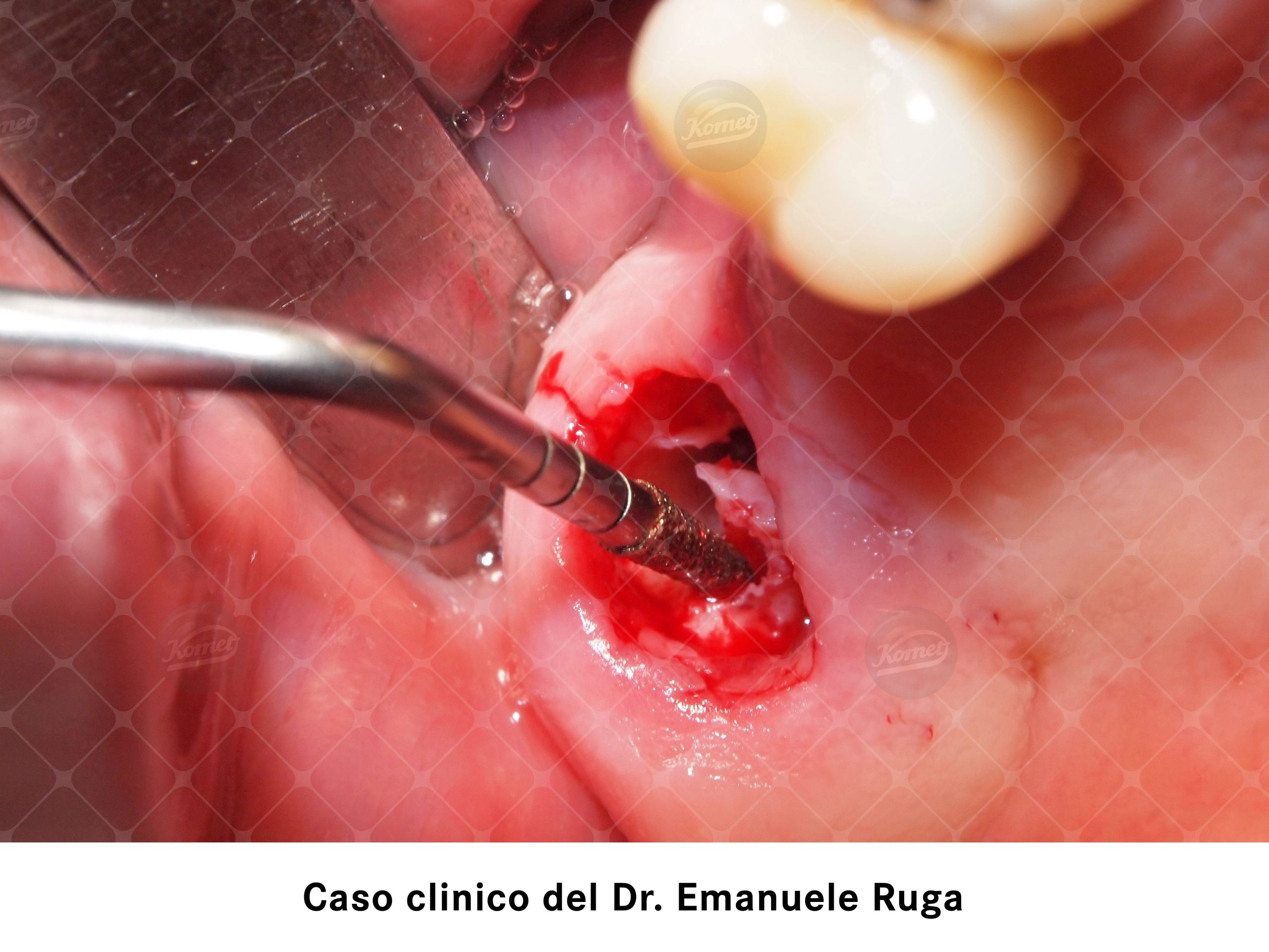 sindesmotomia delicata e un taglio micrometrico, osteotomia peri-radicolare, osteotomia micrometrica sonicadel foro implantare, espansione ossea con viti
