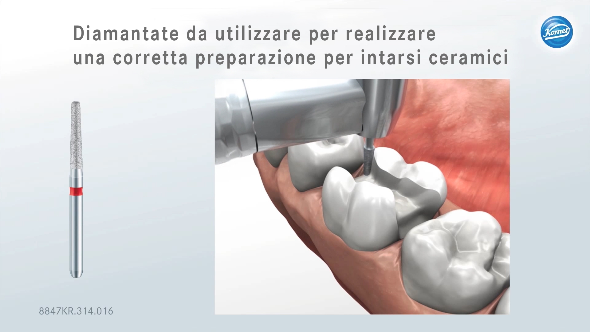 Corretta preparazione per intarsi ceramici con Komet Diamantata 6847KRD, 8862, Punta sonica SFM7, Diamantata 8847KR, 8845KR, 8862, 8959KR, 8379, 8862. Corretta preparazione per intarsi ceramici con Komet Diamantata 6847KRD, 8862, Punta sonica SFM7, Diamantata 8847KR, 8845KR, 8862, 8959KR, 8379, 8862.