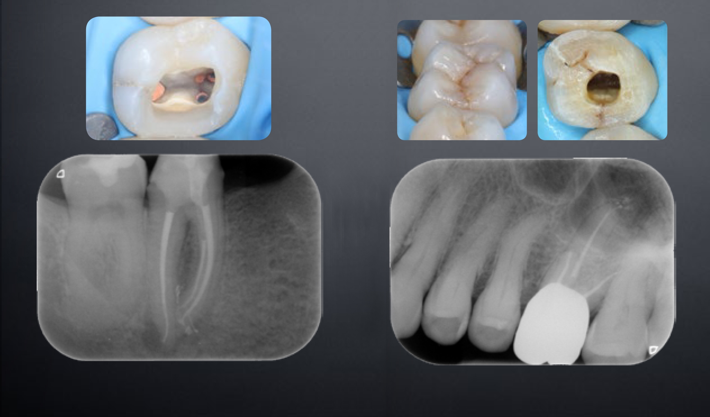 Caso clinico del Dr. Alessandro Fava: ampia lesione endoperio a carico di due incisivi inferiori necrotici con lume canalare molto calcificato.