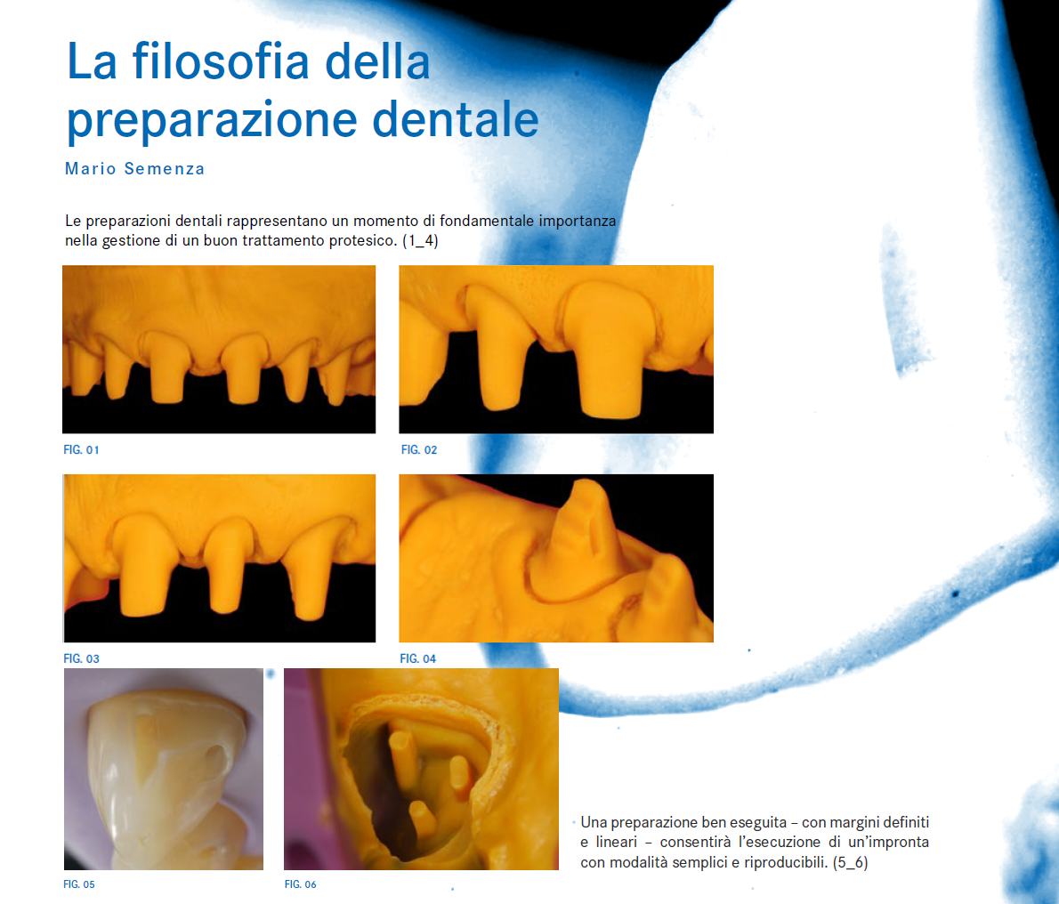 Il kit del Dr.Mario Semenza permette di eseguire preparazioni di protesi con tutte le tipologie di linee di finitura. Contiene molte diamantate di tipo S