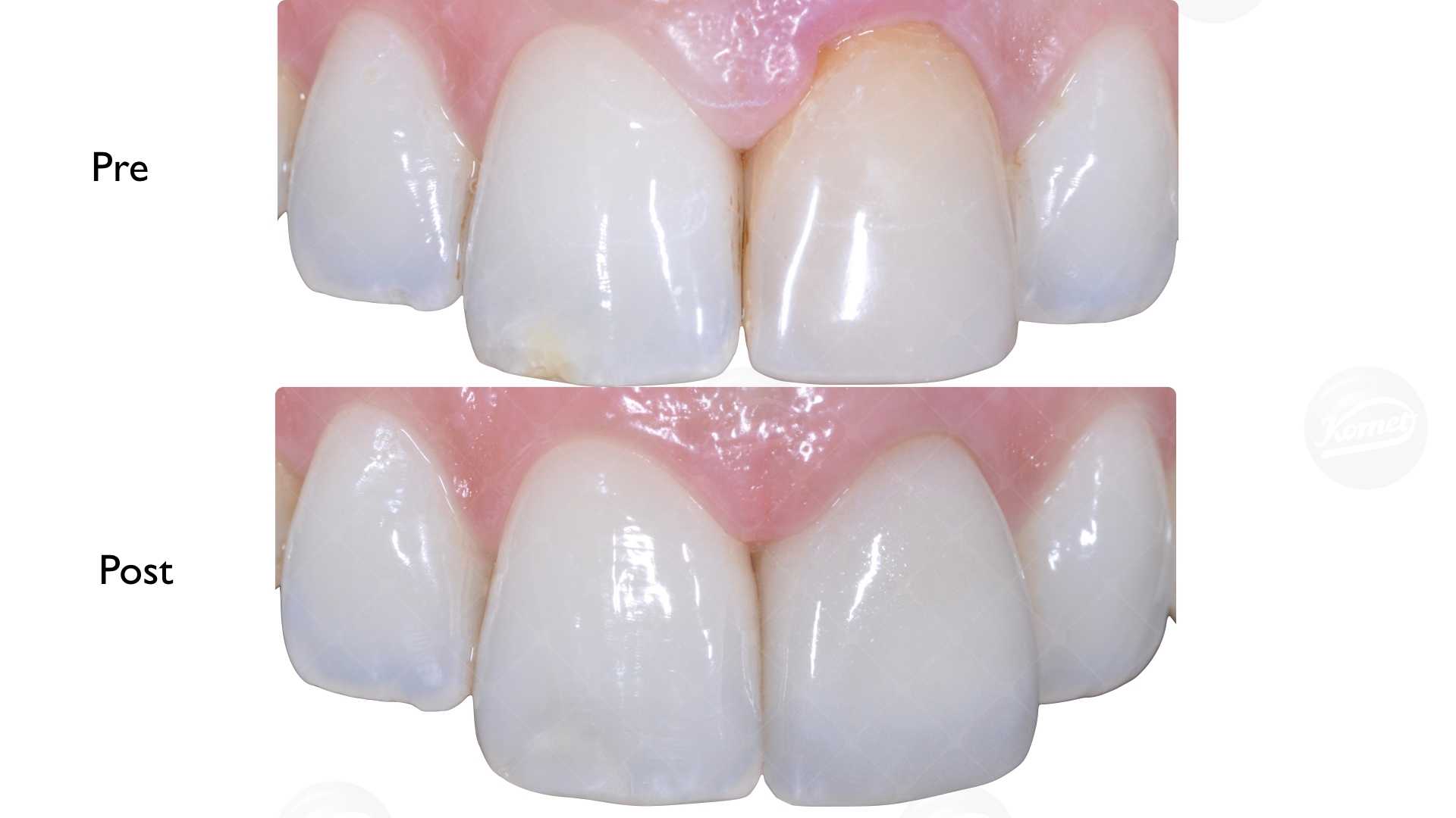 Ritrattamento endodontico e cementazione di un perno in fibra di vetro + preparazione del moncone che sarà rivestito con una corona in disilicato di litio.