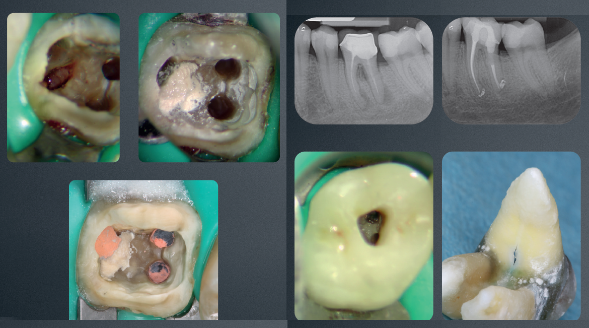 Video del Dr.Alessandro Fava su ritrattamento per via ortograda: per ottimizzare e velocizzare la procedura vengono utilizzati strumenti Komet Endo Re Start