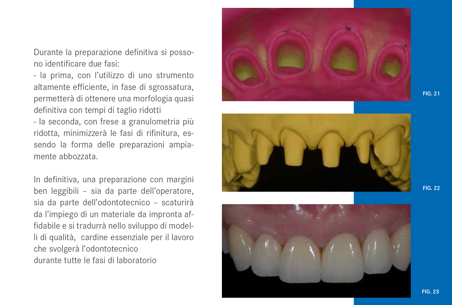 Il Dr. Mario Semenza mostra un protocollo operativo per ottenere una preparazione protesica di Onlay adesivi utilizzando un’unica fresa, la forma Komet 379.