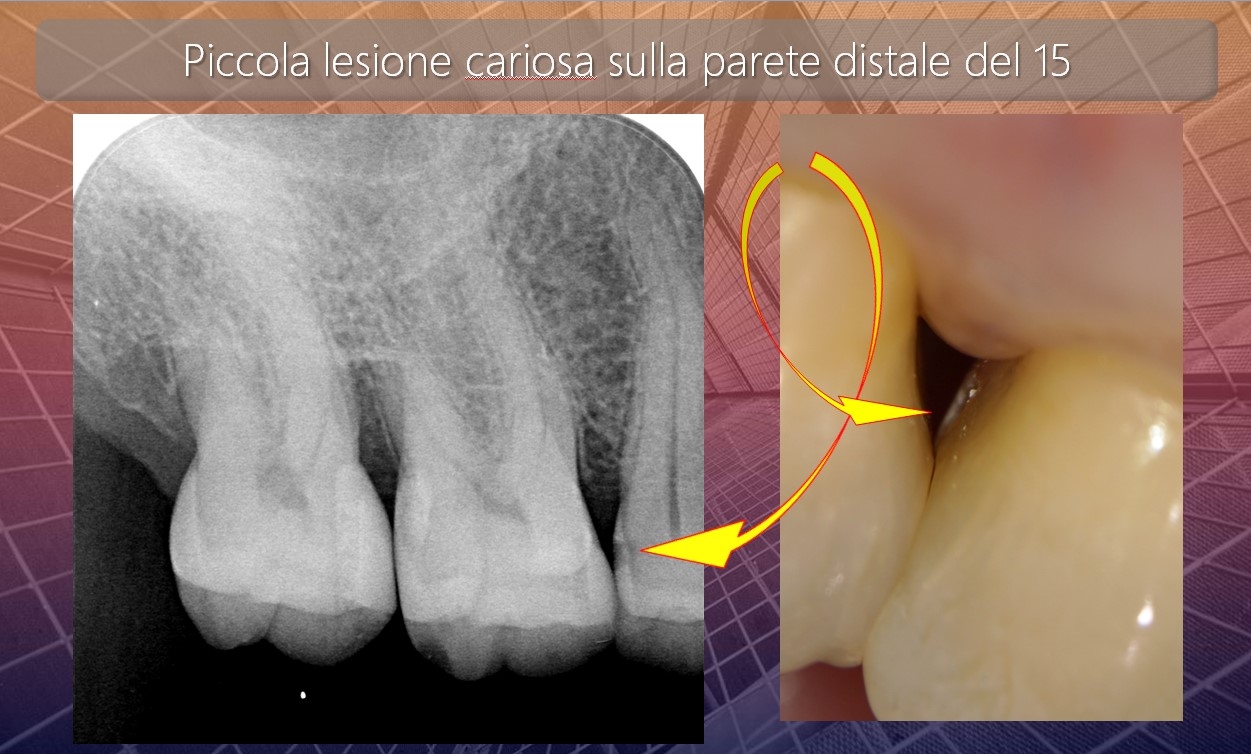 Caso clinico del Dr. Mauro Libertucci: trattamento mini invasivo con frese micro prep di una lesione cariosa della parete distale di un premolare superiore