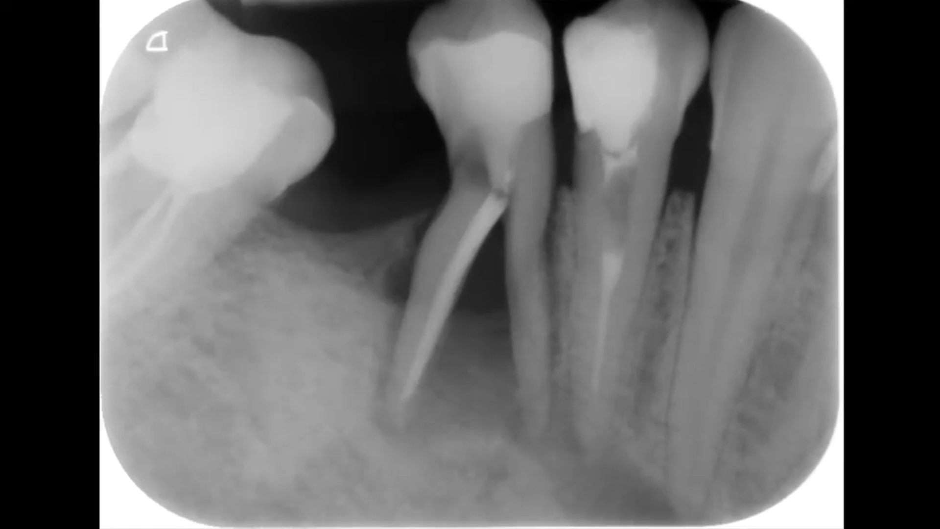 Estrazione del 45 e ritrattamento del primo premolare che, anche grazie all'esame CBCT eseguito, presentava due canali, uno dei quali del tutto ignorato.