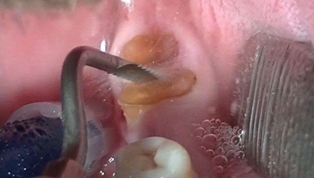 Video della relazione che il Dr. Ruga al Congresso Nazionale 2021 Strumenti sonici, soluzioni innovative per l'operatività clinica