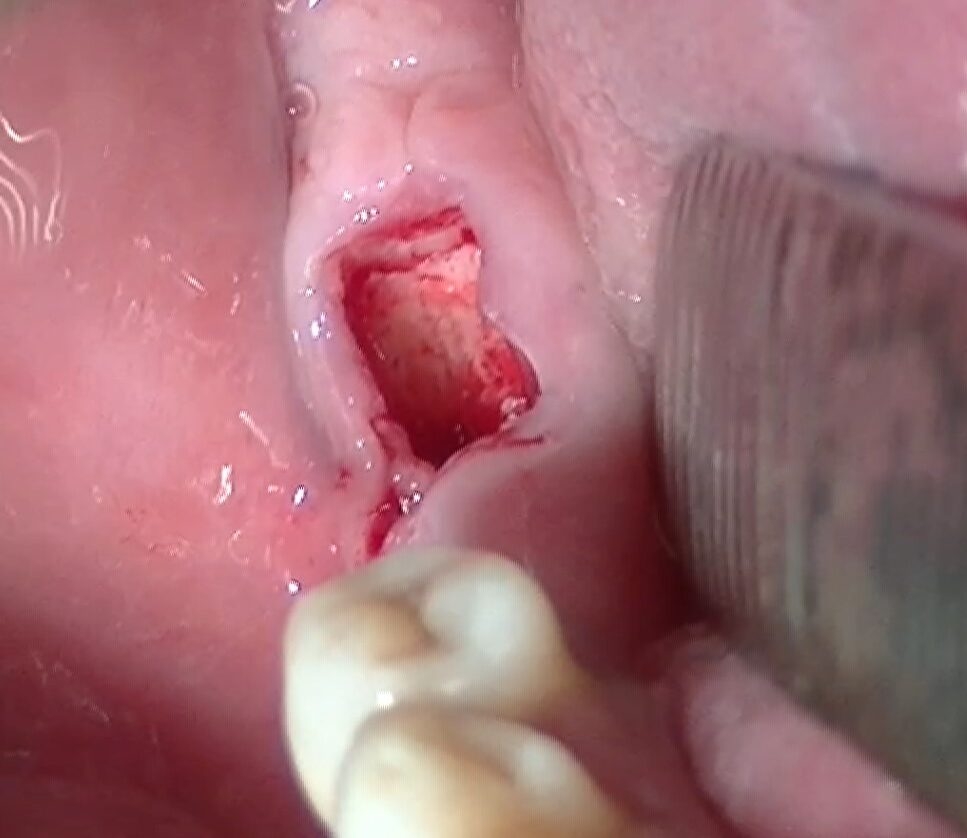 Figura 11 Alveolo post-estrattivo. Grazie alla all’azione precisa ed al movimento micrometrico degli inserti sonici, le pareti alveolari linguali e buccali vengono preservate, senza fratture o deformazioni.
