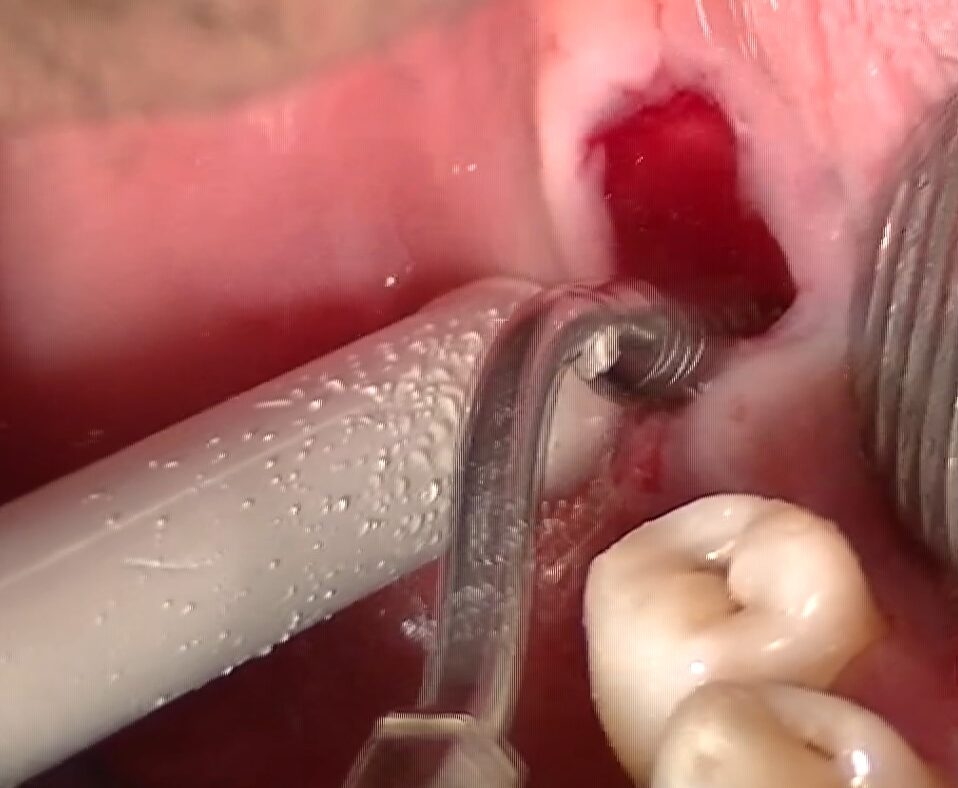 Figura 12 Detersione del sito alveolare post-estrattivo con soluzione fisiologica sterile ed SFS99.033. L’inserto è provvisto di un rivestimento diamantato a grana grossa, efficace nel rimuovere eventuali residui di tessuto di granulazione.