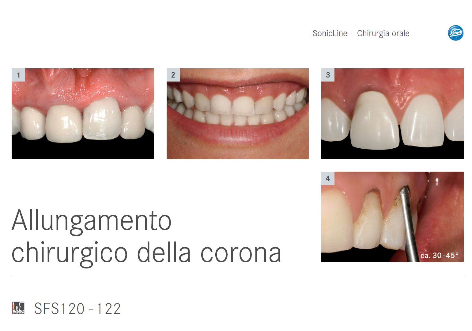 Le Komet SFS120 - SFS121 - SFS122 sono punte soniche specifiche per l’allungamento chirurgico della corona senza apertura del lembo