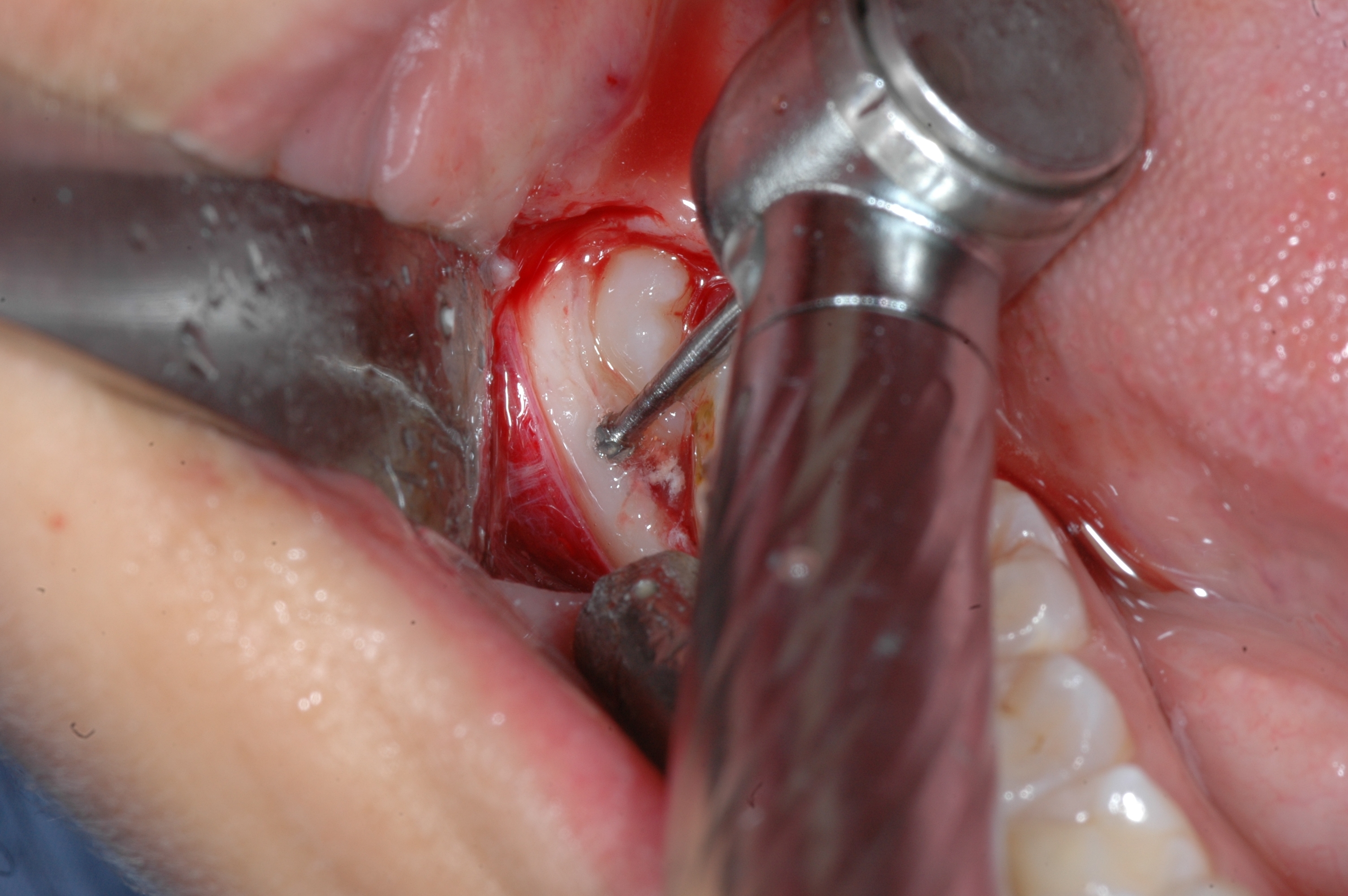 Estrazione di un terzo molare incluso con la tecnica, mini-invasiva e lingual-flapless, dei piercings del Dr. Di Dio con frese H1 316 018 e H31LR 316 016