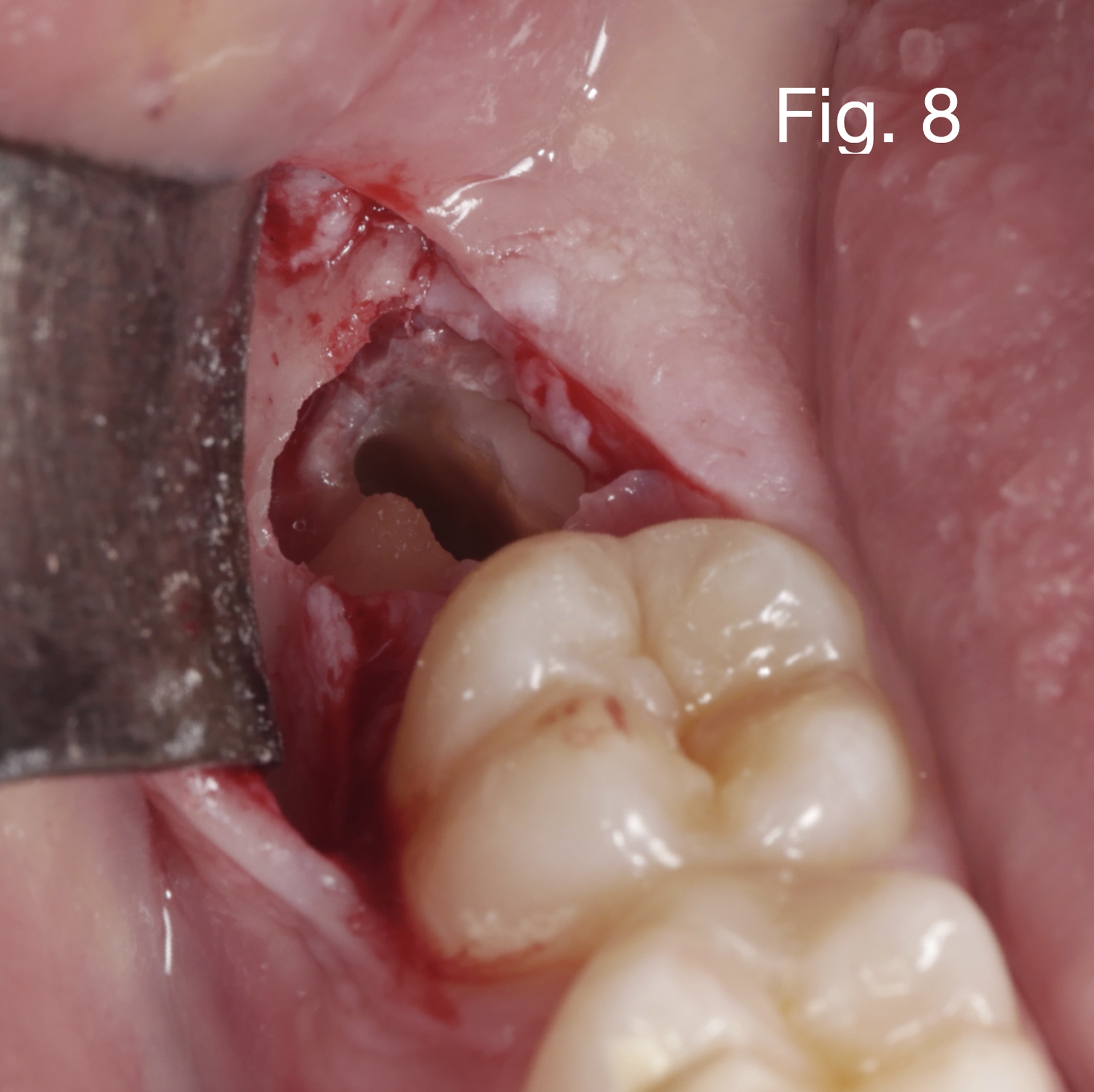 Caso clinico Dr. Baleani fig8