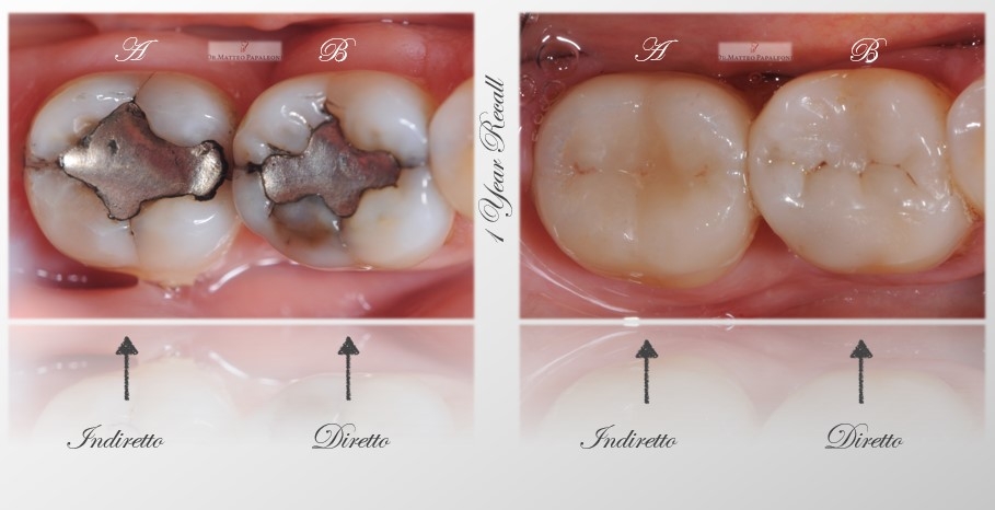 Caso clinico del Dr. Papaleoni che pone in comparazione soluzioni overlay diretto vs indiretto in elementi con Sindrome del Dente Incrinato