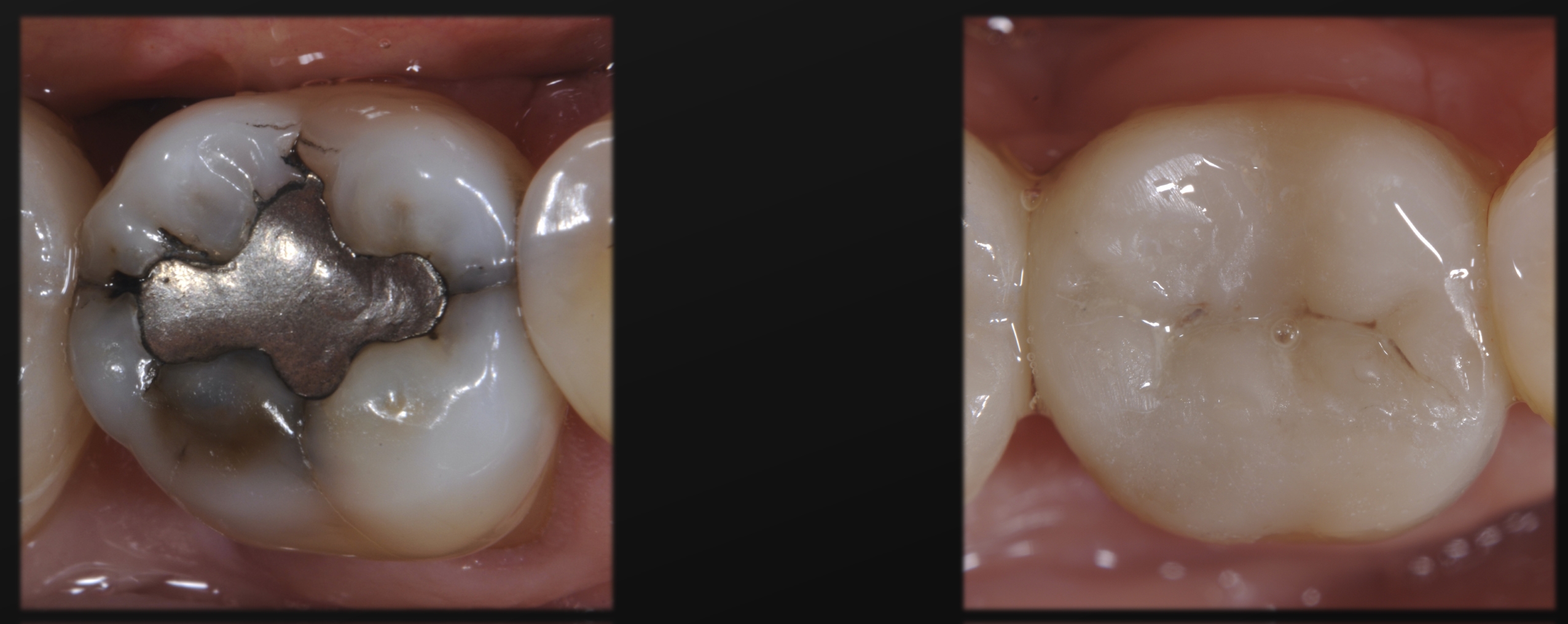Caso clinico 17 Dr Papaleoni Komet Academy dente pre e dente post