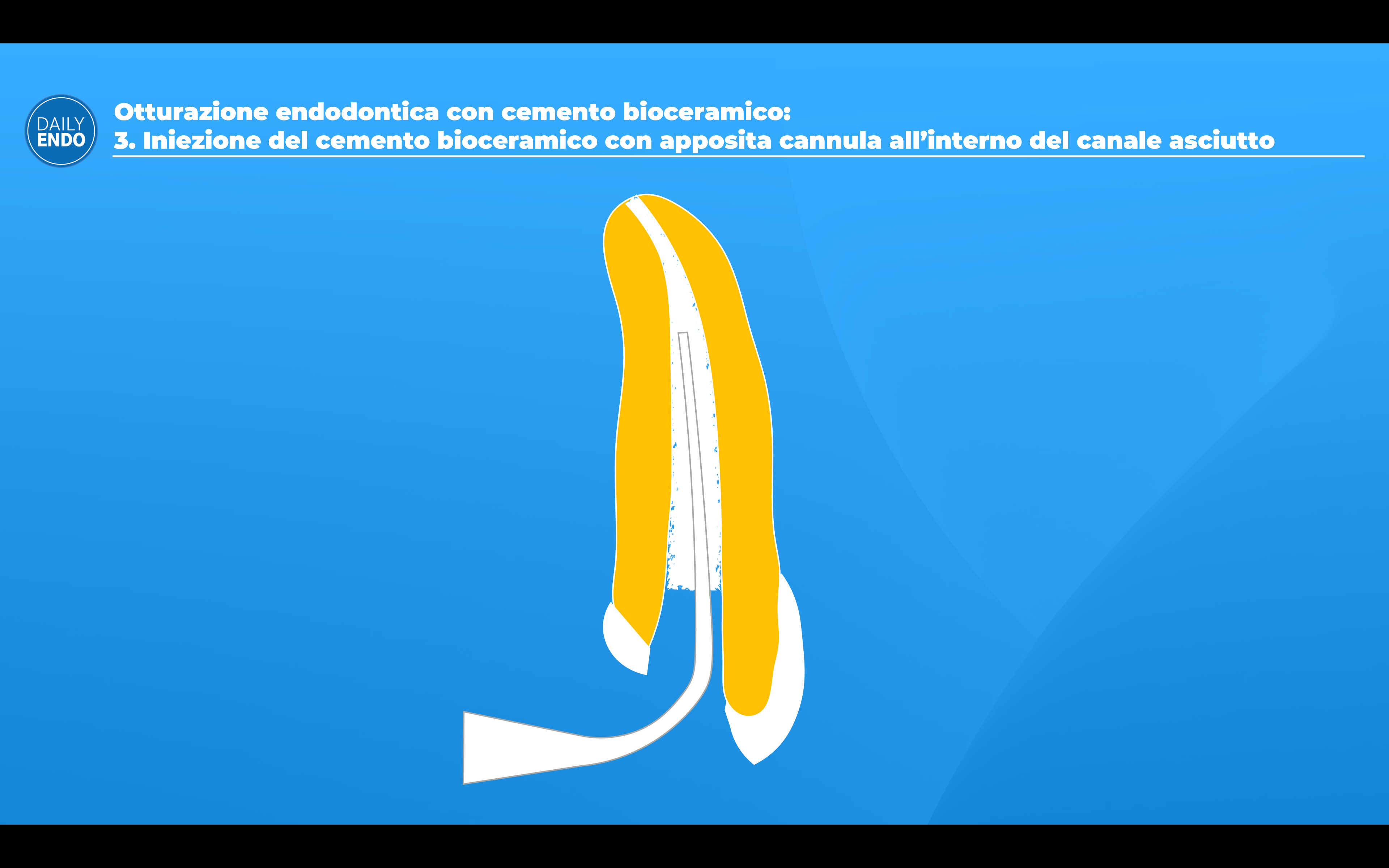 Il legame adesivo e la stabilita dimensionale del bioceramico BioSeal prevengono nuove infezioni indesiderate del canale radicolare