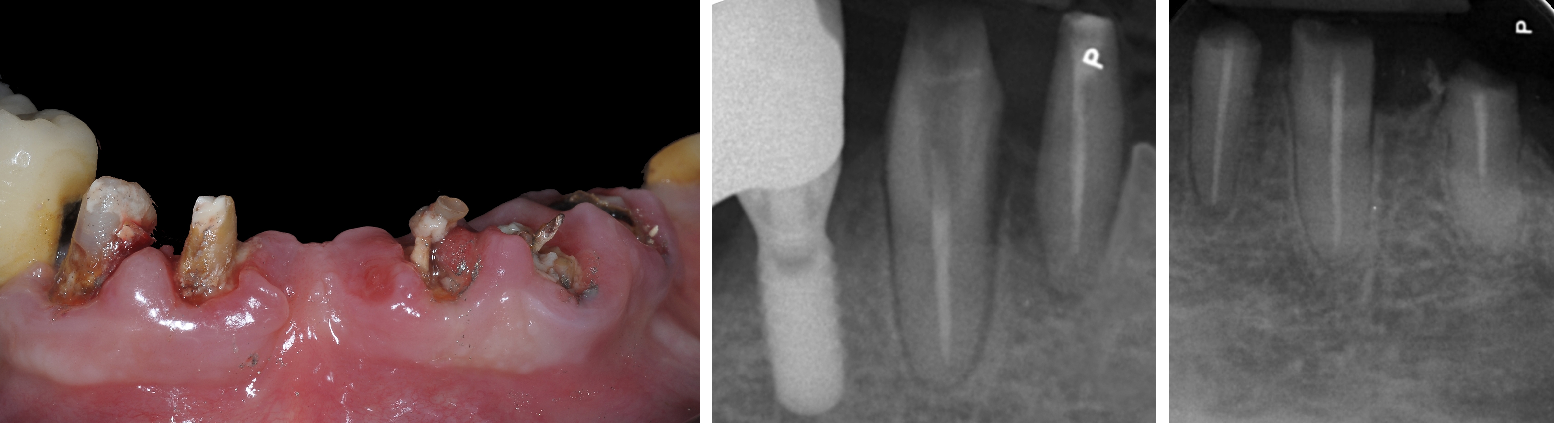 2, 3.a, 3.b - Foto consolidate - Esame obiettivo e radiografico che evidenzia una compromissione cariosa - Caso Dr. Mario Semenza