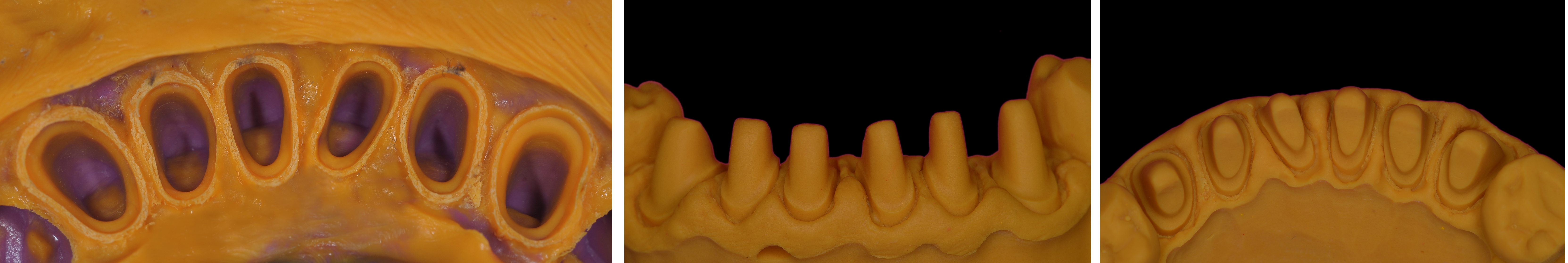 Il Dr. Mario Semenza espone un interessante caso di restaurativa con utilizzo di corone in zirconia monolitica.