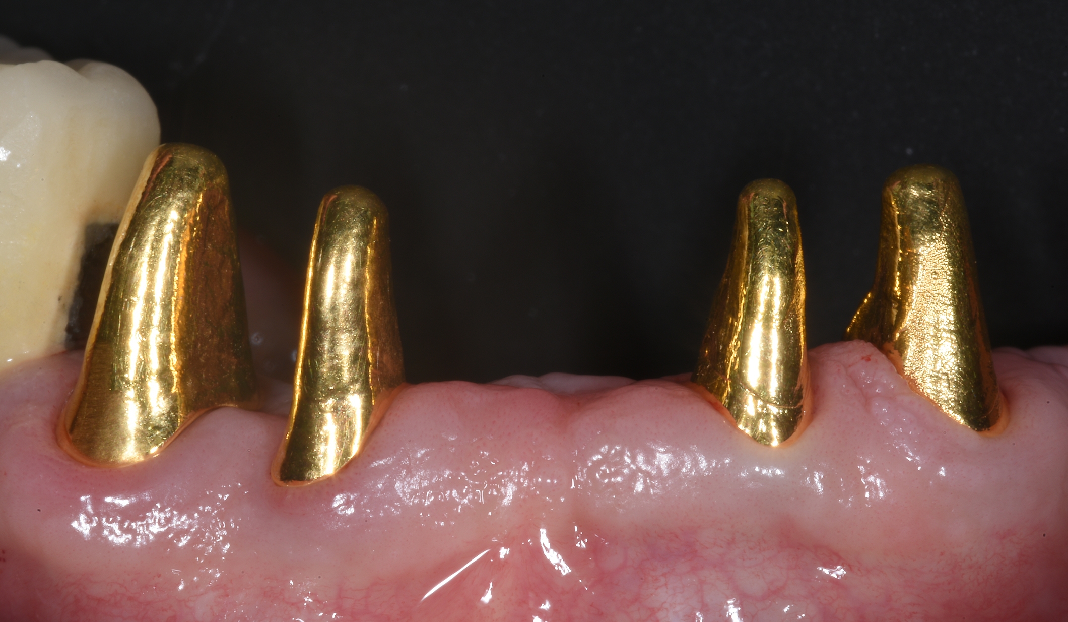 Caso clinico del Dr. Mario Semenza: preparazione con geometria verticale pur mantenendo una linea di finitura