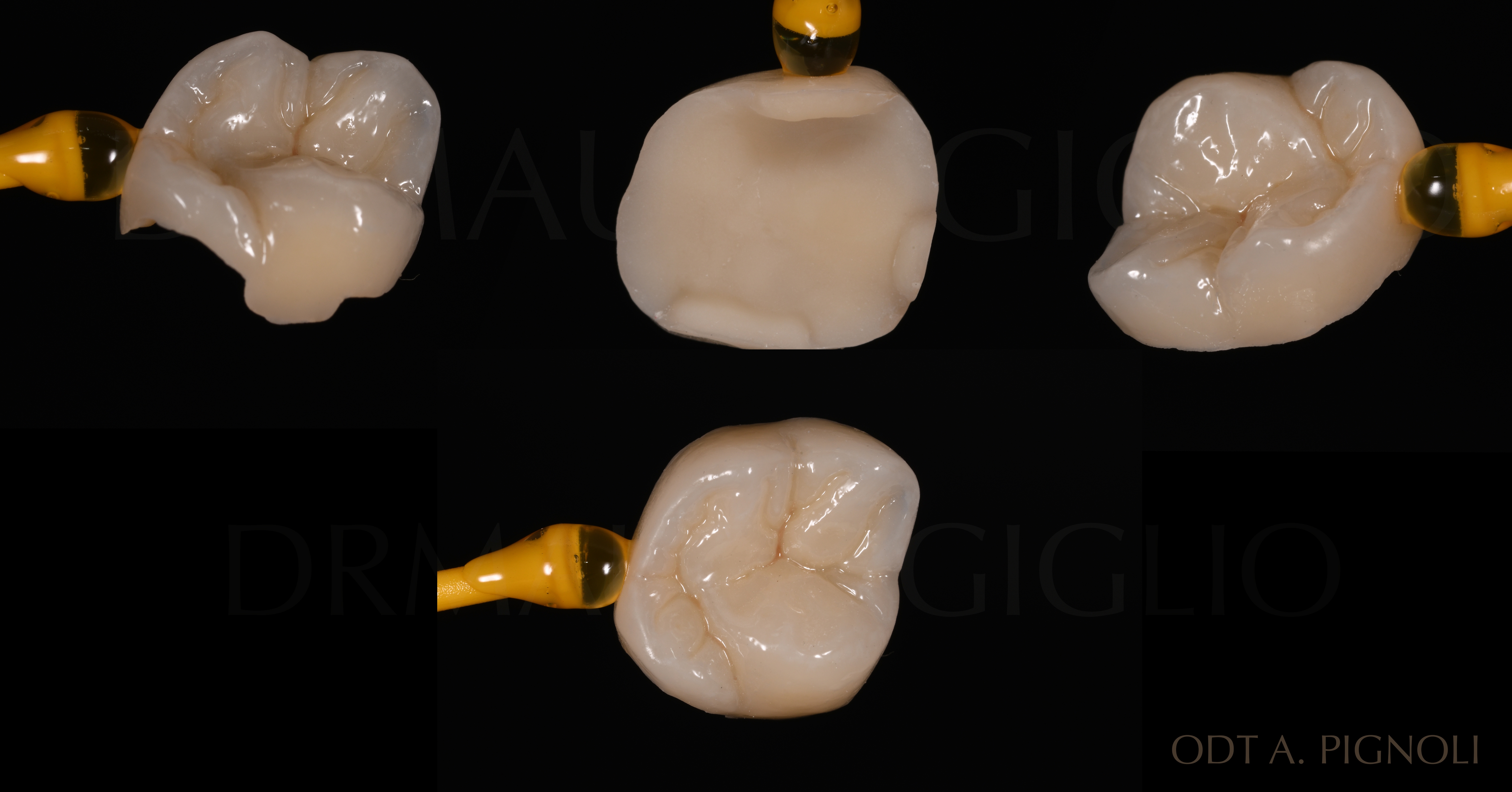5 - Dr. Maglio Giglio, caso sul ritrattamento canalare - Intarsio realizzato dall’odontotecnico Alberto Pignoli