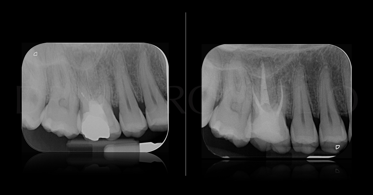 Caso clinico del Dr. Mauro Giglio su un ritrattamento canalare del sedicesimo elemento con strumentazione endodontica Komet