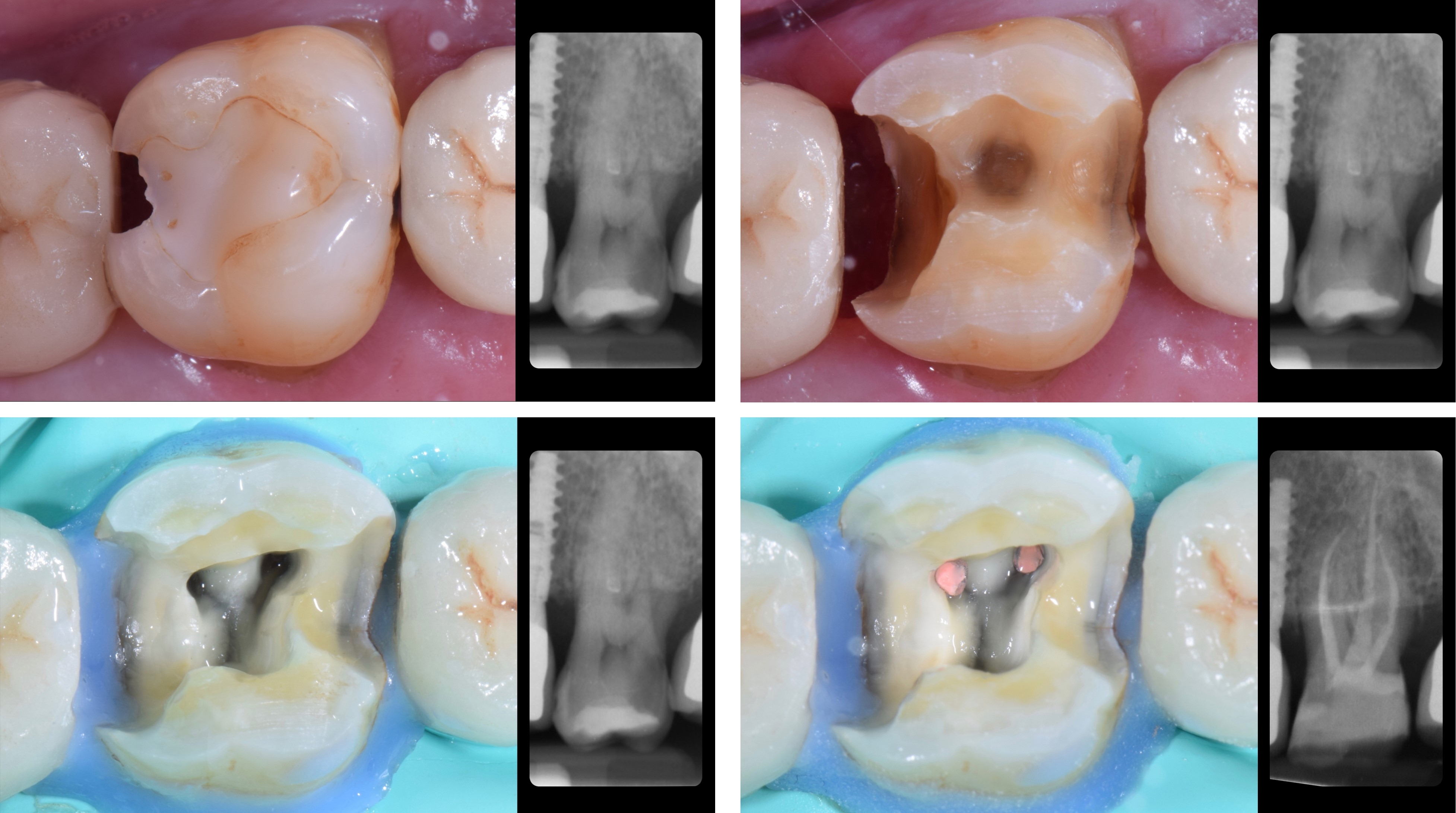Caso clinico Dr. Pittaluga 1-2-3-5 sulla terapia canalare del dente incisivo