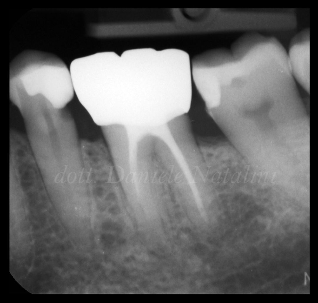 RX0 caso clinico Dr Natalini