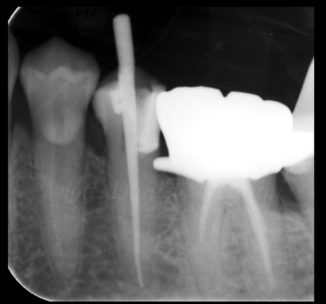 RX1 caso clinico Dr Natalini