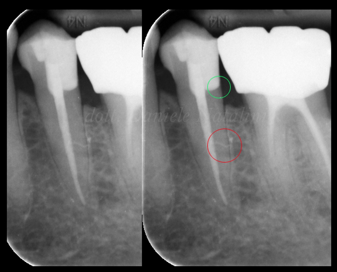 RX2 caso clinico Dr Natalini